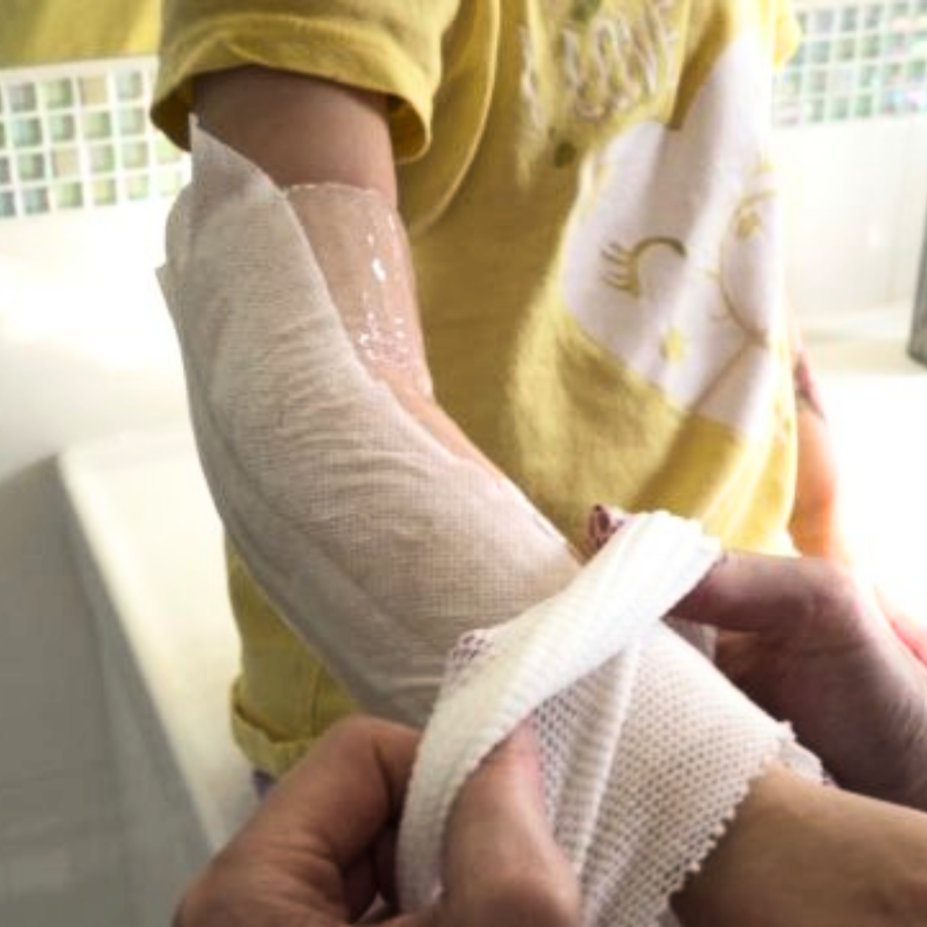 opatrunek hydrożelowy na poparzonej ręce dziecka